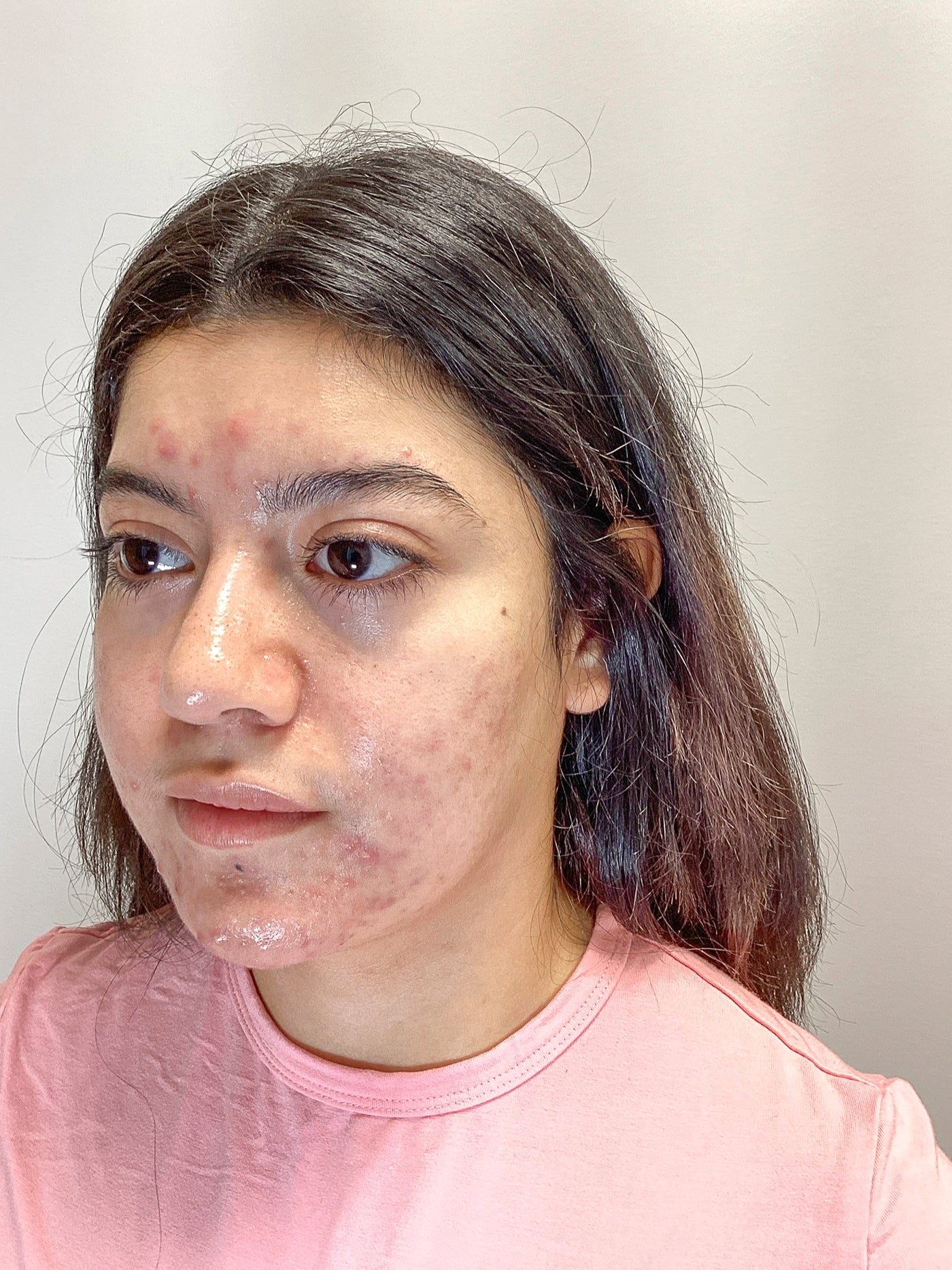 Can Acne Be Itchy?