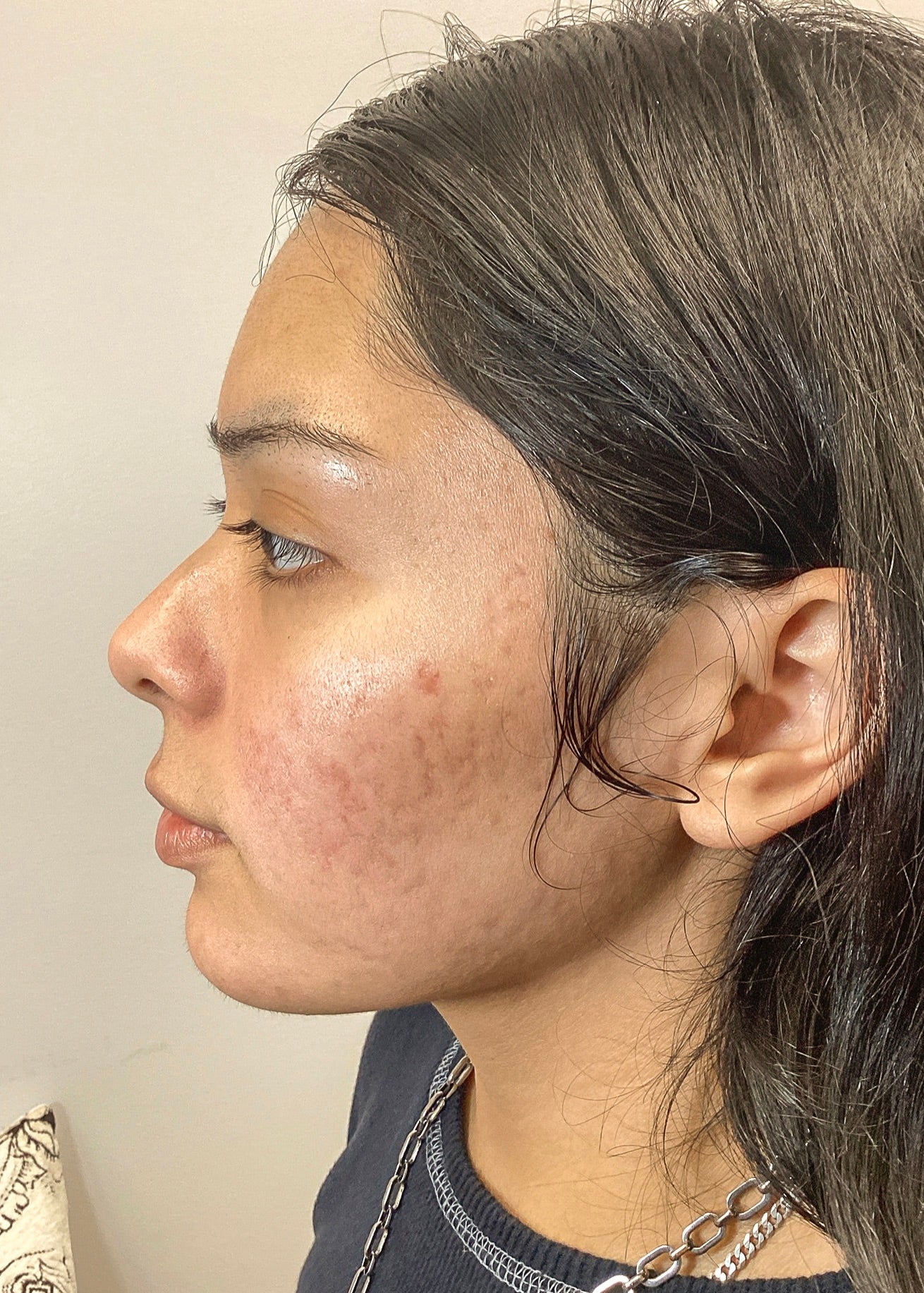 Why are acne scars red?