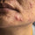 Types of Acne (And How to Treat Them) - LEINE The Seattle Acne Clinic & Wellness Spa