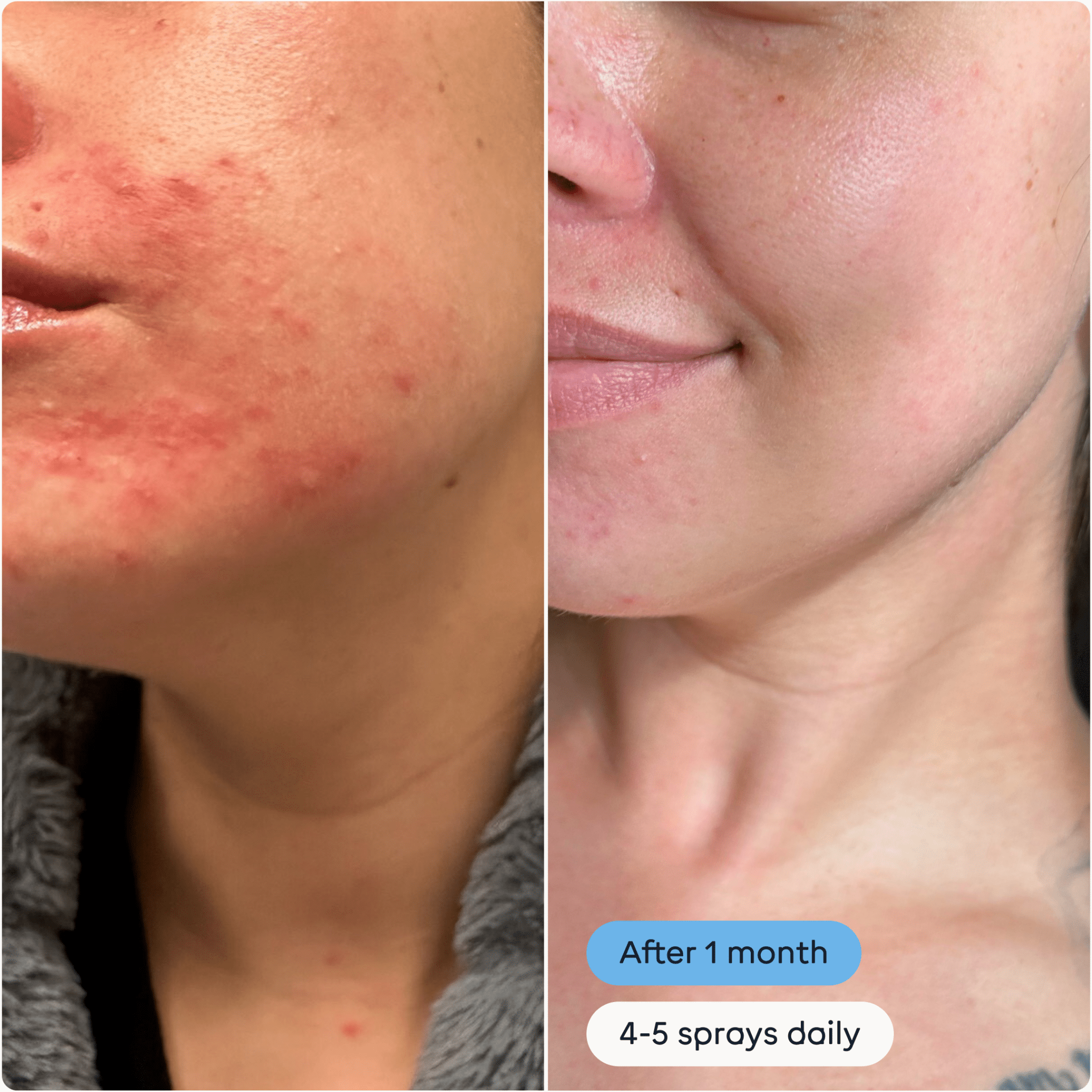 Magic Molecule Daily Skin Spray Hypochlorous Acid Spray - LEINE The Seattle Acne Clinic & Wellness SpaMagic Molecule