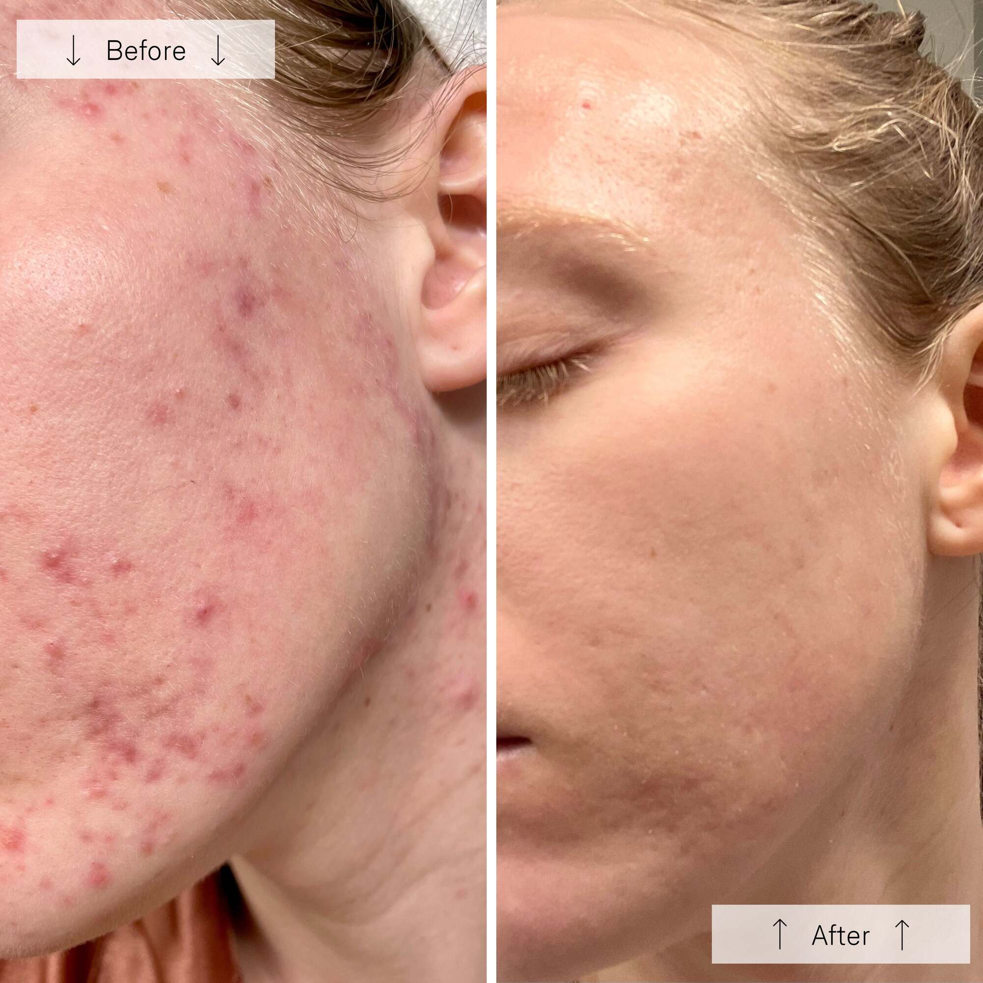 Omnilux Clear | Blue + Red LED Device for Acne - Omnilux - Omnilux