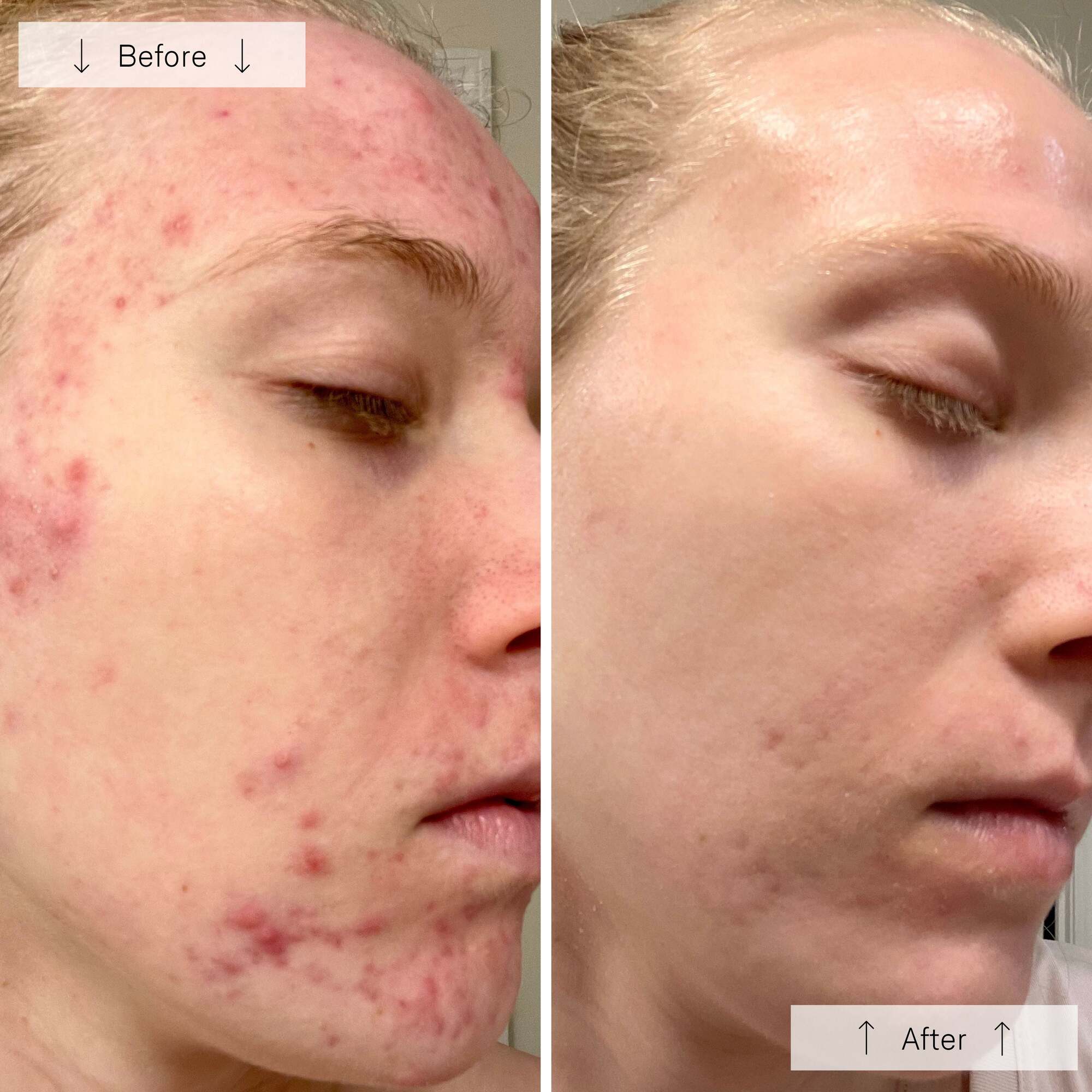 Omnilux Clear | Blue + Red LED Device for Acne - Omnilux - Omnilux