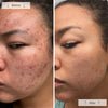 Omnilux Clear | Blue + Red LED Device for Acne - Omnilux - Omnilux