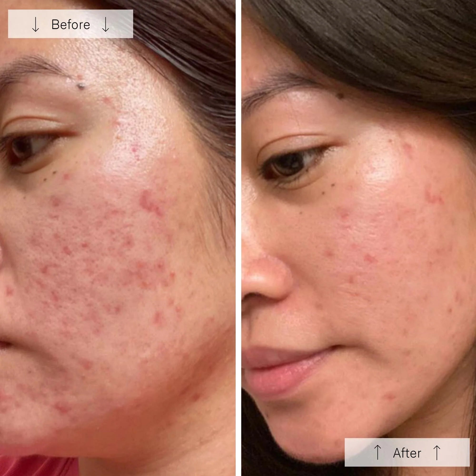 Omnilux Clear | Blue + Red LED Device for Acne - Omnilux - Omnilux