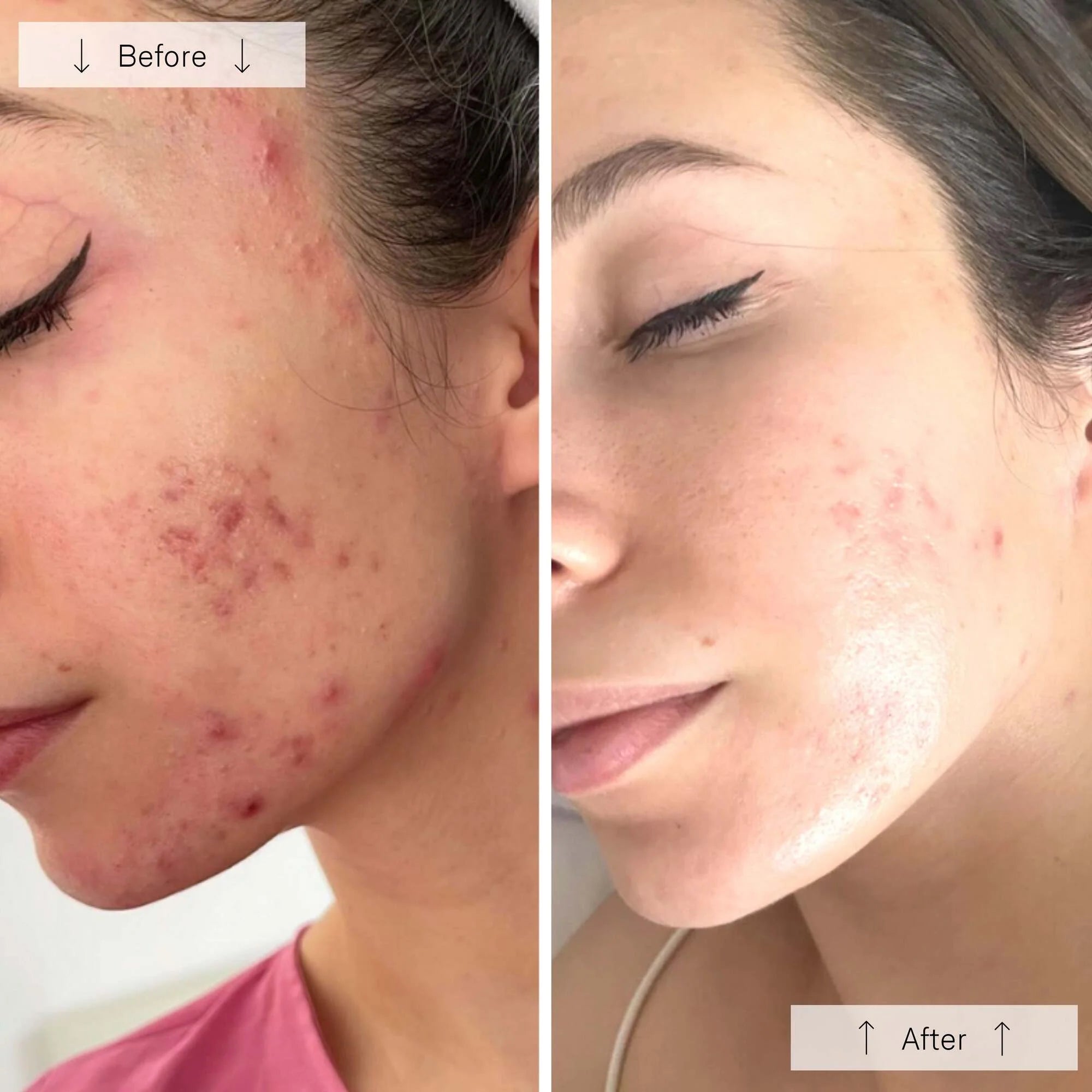 Omnilux Clear | Blue + Red LED Device for Acne - Omnilux - Omnilux