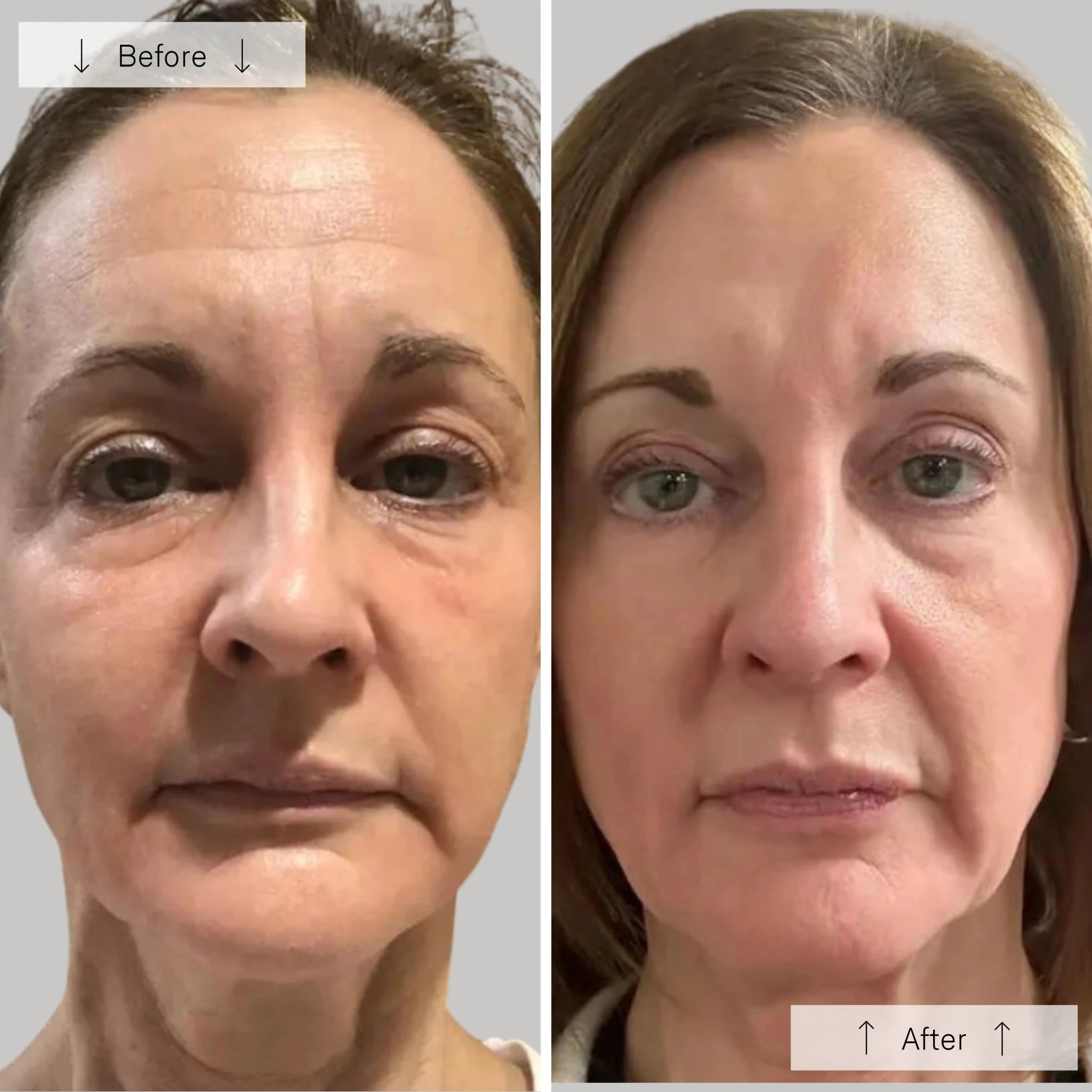 Omnilux Contour Face | Red Light Therapy Mask - Omnilux - Omnilux