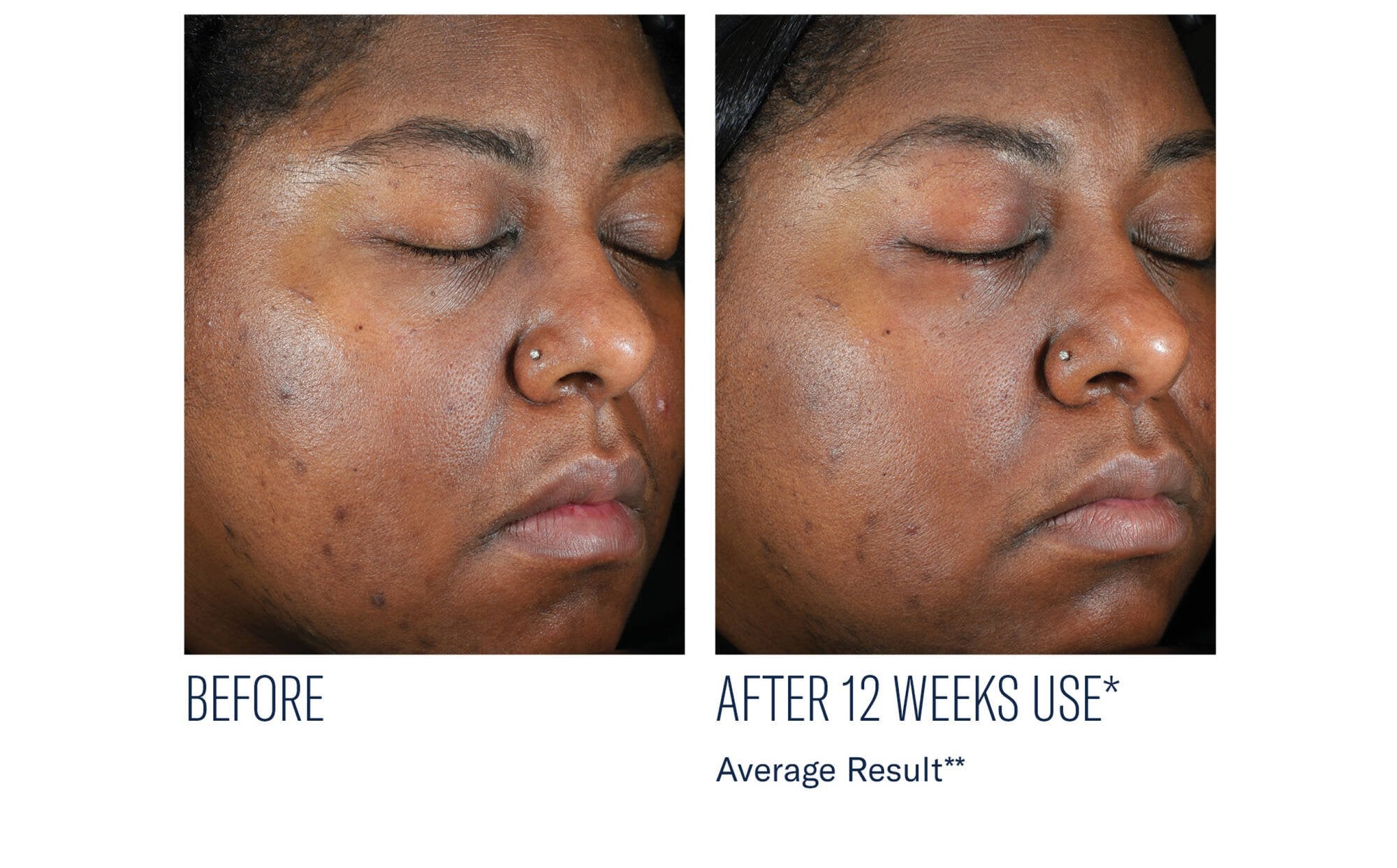 SkinBetter Even Intensive Skin Tone Correcting Serum - SkinBetter Science - SkinBetter Science